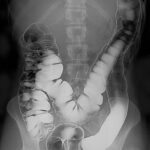 Barium Enema Double With Contrast