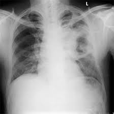 CECT Chest and HRCT Cut