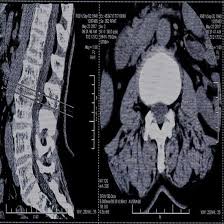 CECT Lumbar Spine