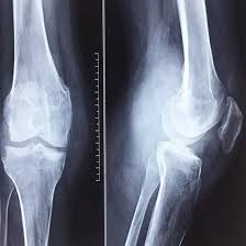 CECT Right Knee Joint