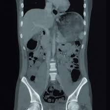 CECT Upper & Lower Abdomen