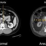 CT Abdominal Aorta