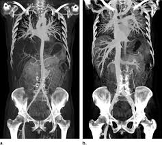 CT Angiography Thorax