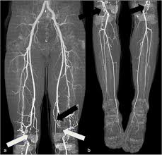 CT Angiography Venous Lower Limb
