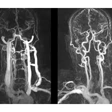 CT Head & Neck Angiography