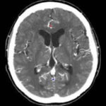 CT Head Plain and Contrast