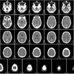 CT Head Scan