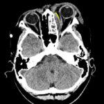 CT Head and Left Orbit