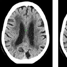 CT Intracranial Vessels