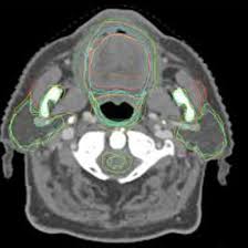 CT Neck With Oral Cavity