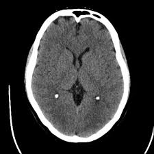 CT Scan Brain
