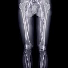 CT Scanogram