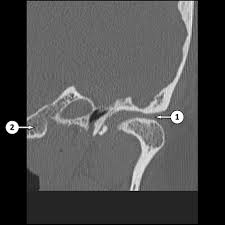 CT Temporal Bone Coronal
