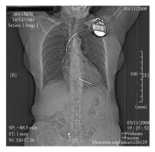 CT Topogram