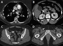 CT Venography
