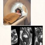 Fetal MRI Scan