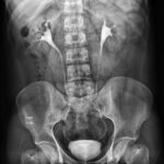 Intravenous Urography (IVU) | Medintu