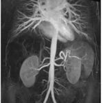 MR Angiography Abdomen