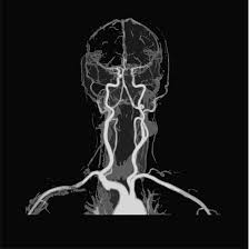 MR Angiography Brain And Neck