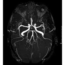 MR Angiography Brain With Contrast
