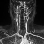 MR Angiography Neck