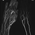 MR Angiography of Hand