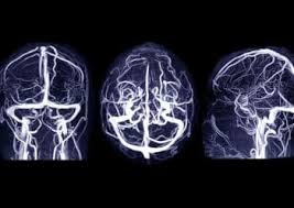 MR Venography Brain