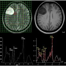 MRI 3D Multivoxel Spectroscopy