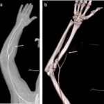 MRI Angiography Upper Limb