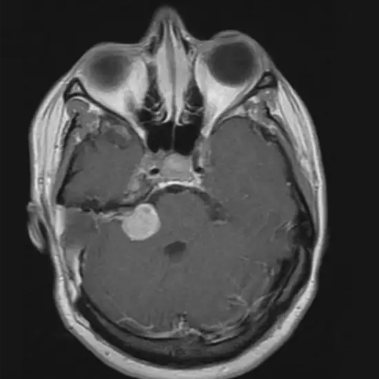 MRI BRAIN WITH CP ANGLE pic