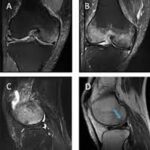 MRI Both Knee Joint