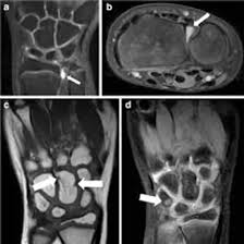 MRI Both Wrist Joint