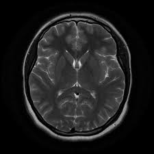 MRI Brain Plain