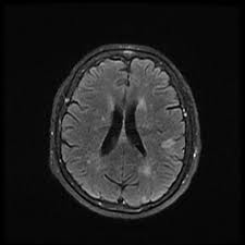 MRI Brain Stroke Protocol