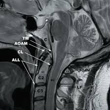 MRI CV Junction