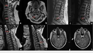 MRI Cervical Lumbar Spine
