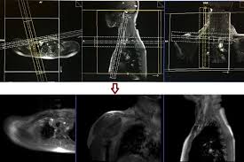MRI Clavicle