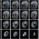 MRI of Dizziness and Vertigo Protocol