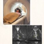 MRI Fistulography
