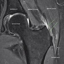 MRI Gluteal and Spine