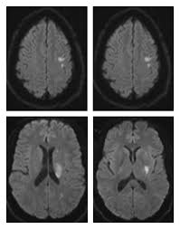 MRI Head Screening With DWI