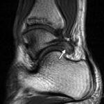 MRI Heel