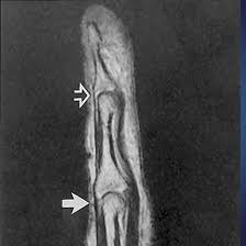 MRI Index Finger