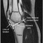 MRI Joint Screening Of Left Knee
