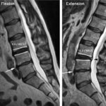 MRI LS Spine Extension