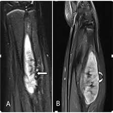 MRI Left Arm