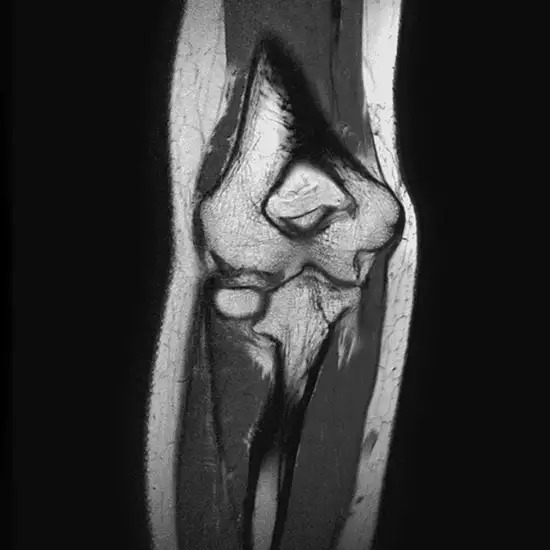 MRI Scan For Left Elbow Joint | Medifyhome
