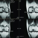 MRI Left Knee Joint