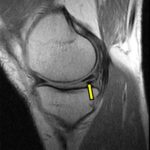 MRI Left Knee With Contrast
