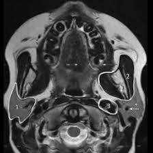 MRI Left Parotid Region